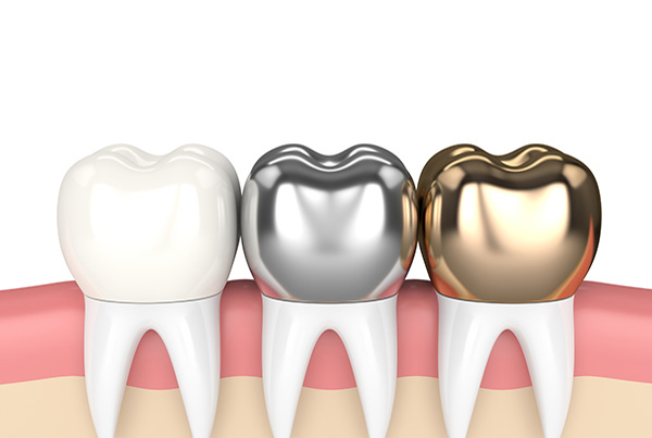 Dental Crown Implant